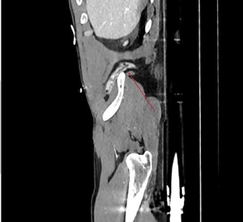 Sagittal view demonstrates the inferior lumbar hernia (red arrow).