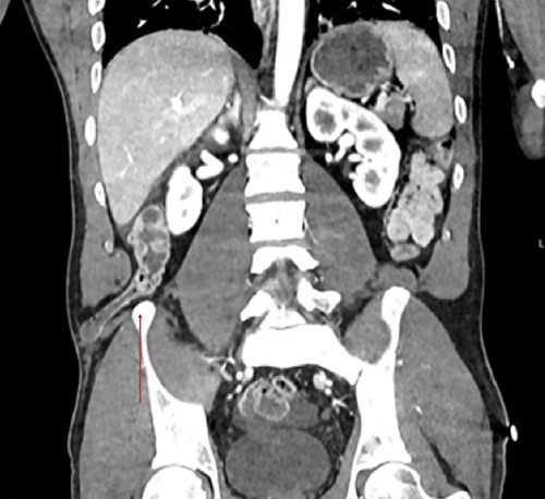 Coronal view showcases the inferior lumbar hernia above the iliac crest (red arrow).