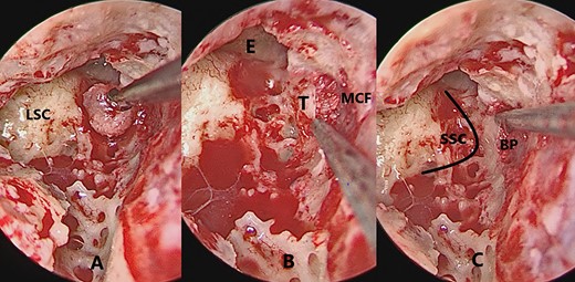 The figure shows serial images of the intervention. (A) Bone patè size that will be inserted into the breach. (B) Bone patè insertion in the gap created between the wall and the meninx of the MCF. (C) Distance of SSC eminence from the bone patè entry. LSC, lateral semiciruclar canal; E, eminence; T, tegmen; MCF, middle cranial fossa; SSC, superior semicircular canal; BP, bone patè.