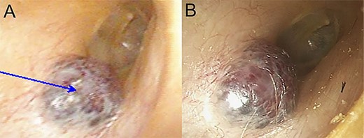 Otoendoscopic view of reddish, soft mass in the EAC; (A) at the time of the initial endoscopic examination; (B) 3 years after the initial endoscopic examination; a tumor had grown slowly, extending medially.