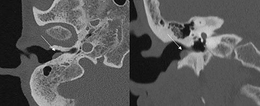 Axial and coronal CT scans showing a soft tissue mass (marked by the arrows) in the EAC without involvement of the tympanic membrane.