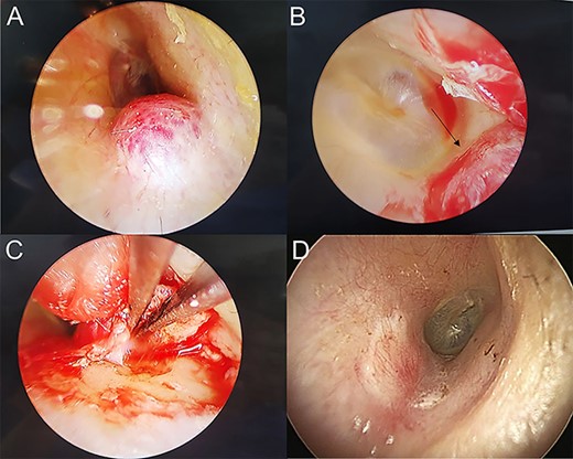 (A) Mass in right EAC; (B) Medial border (marked by arrow) of the mass near tympanic membrane was observed by endoscope; (C) excised mass and cauterized the feeding vessel with bipolar cautery; (D) 3 months after surgery, the EAC was covered by the perichondrium graft.