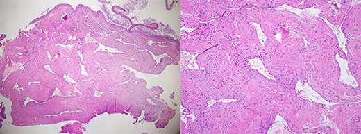 Histopathological image showing features of cavernous hemangioma (H&E stain, ×40, ×100).