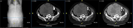 Axial computed tomography (CT) scan shows solid mass in abdominopelvic cavity.