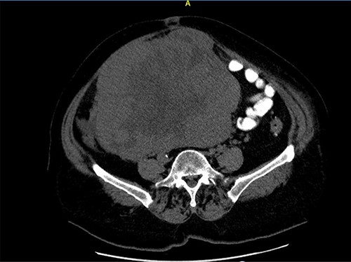 Close picture of axial CT scan of tumor, showing more right-sided localization.