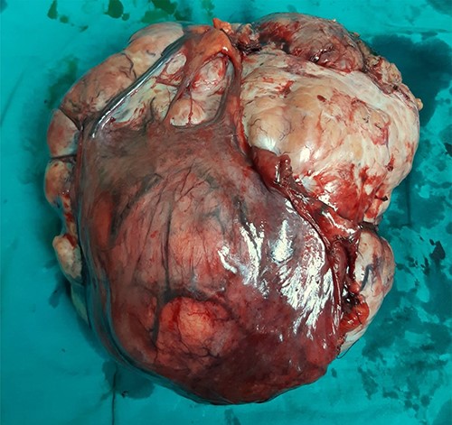 Surgically removed tumor mass that was sent to pathology, mostly right ovary and adnexa with unremarkable cervix.