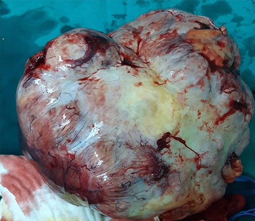 Surgically removed tumor mass, anterior side view.