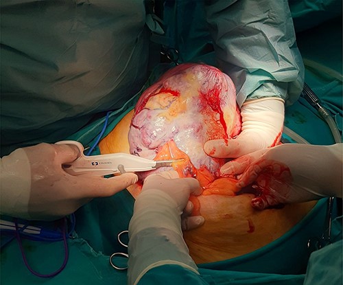 Intraoperative image of removal of the tumor from surrounding tissue and neovascularization: large mass identified following opening of the peritoneal cavity.