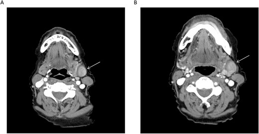 (A, B) Axial CT cuts of the neck with contrast revealing the lesion in the left submandibular neck (arrow); retrospective review demonstrates communication of the lesion with the adjacent left external jugular vein.