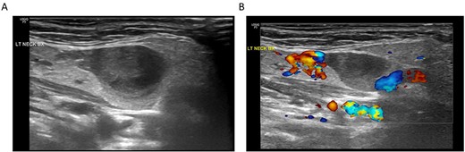 (A) Ultrasonography of the submandibular neck lesion; (B) ultrasonography of the lesion with color Doppler; the apparent lack of flow within the venous aneurysm is likely related to the imaging technique and relatively slow flow within the aneurysm compared to the adjacent external jugular vein.