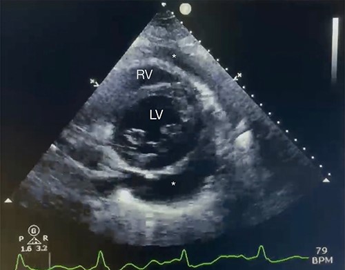Echocardiography with moderate pericardial effusion: subcostal 2 chamber echocardiography view demonstrating * = pericardial effusion, RV = right ventricle and LV = left ventricle.