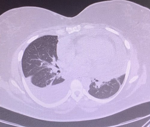 Chest CT with pericardial and right pleural effusion.