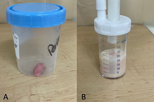 Pericardial biopsy and fluid: labeled as biopsy (A) and fluid (B).