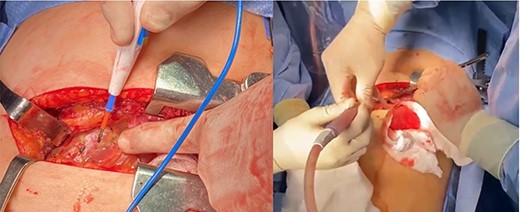 Left lateral thoracotomy with pericardial window.