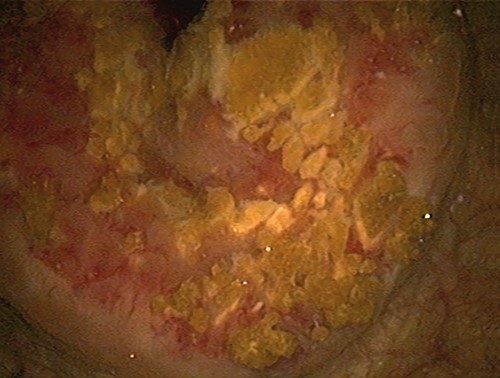 Intraoperative view of urethral prostatic calcifications.