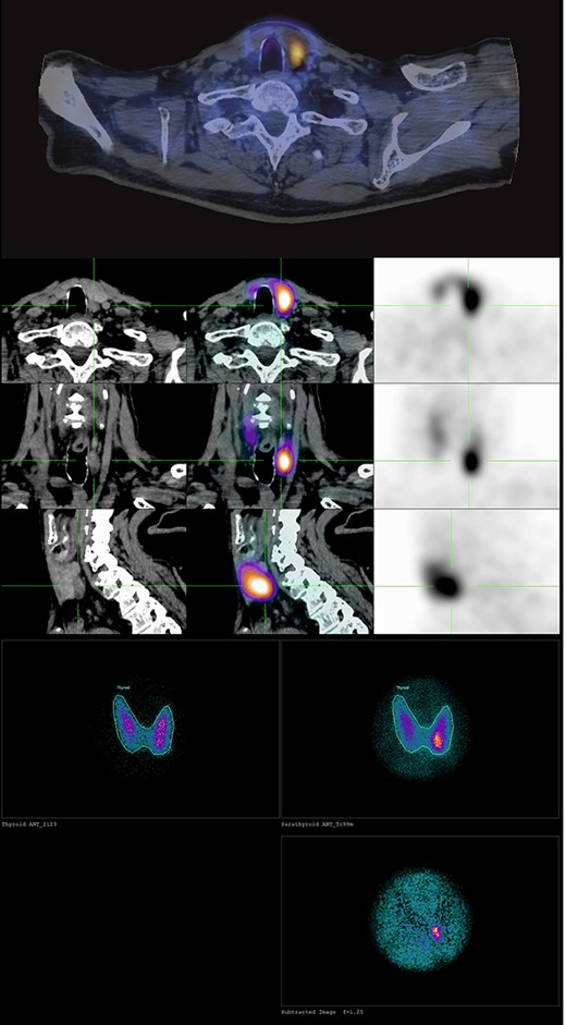 Scintigraphy with single-photon emission computed tomography images of the left inferior parathyroid adenoma.