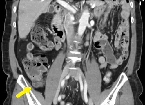 CT scan coronal view: dilated appendix with fat stranding.