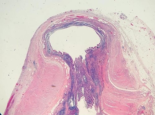 Pathology slide: diverticulosis of the appendix.