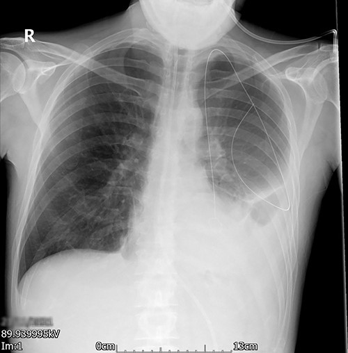 Posterior–anterior chest radiograph after chest drain insertion showing the retained guidewire in the left pleural cavity. In addition, left pleural effusion can be noted.