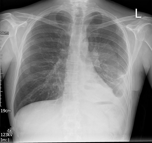 Left VATS post-operative posterior–anterior chest radiograph showing no guidewire in the left pleural cavity.