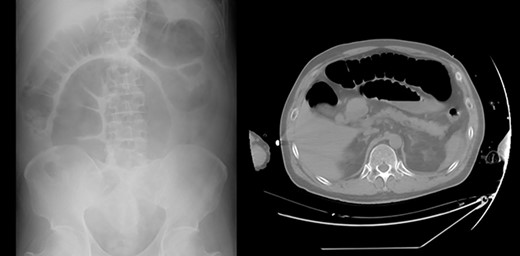 Pseudo-intestinal obstruction in the postoperative period.