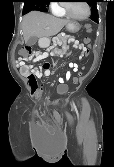 Coronal view of the pre-operative abdominal CT. The appendix was incarcerated inside the inguinal hernia and surrounded by a large amount of simple fluid.