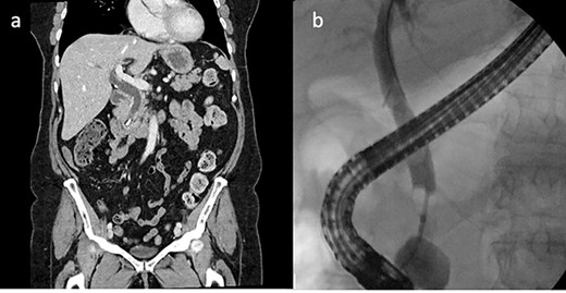 CT abdomen and ERCP. (a) CT abdomen showed a linear high density focus consistent with a 10-mm surgical clip obstructing the distal CBD, which was significantly dilated proximally (coronal). (b) ERCP showing filling defect in CBD.