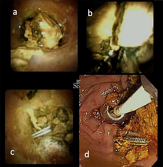 ERCP with spyglass cholangioscopy. (a) Bile duct stone obstructing CBD. (b) EHL fragmentation of stone. (c) Two Surgical clips freed from stone material. (d) Biliary tree swept with balloon and basket.