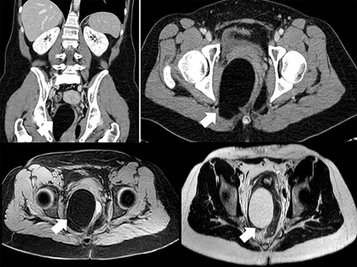 CT and MRI of the tumor.