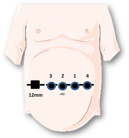Trocar positioning.