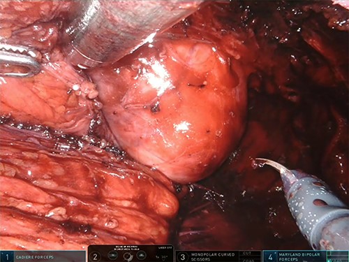 Intraoperative findings.