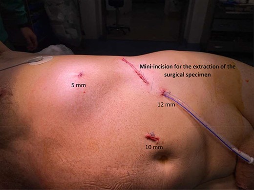 Usual working port configuration for nephrectomy. The left 5 mm port incision is always placed over the lower ribs in case of left radical or simple nephrectomy. However, in the case of nephroureterectomy, we prefer to use a 10 mm trocar in that position (rather than a 5 mm trocar) in an attempt to move the camera from a different point of view. This strategy allows us to better perform the dissection of the ureter near the bladder.