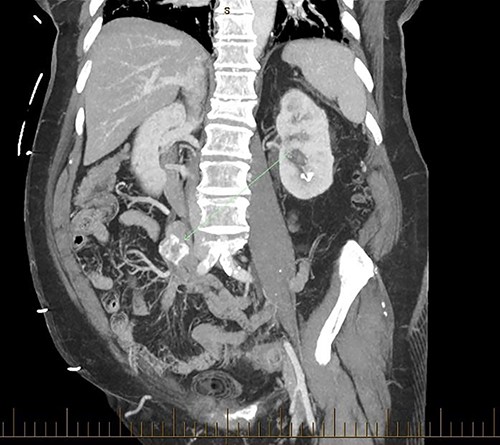 Coronal CT BC embedded in the distal jejunum.