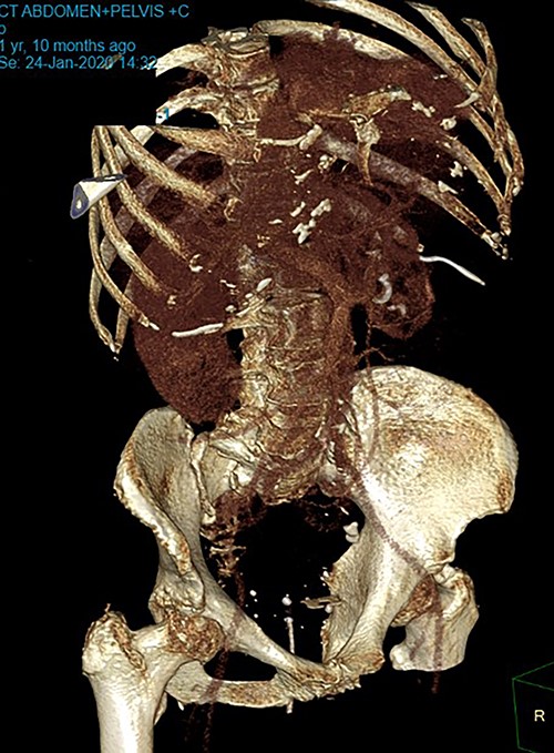 CT reconstructed image, BC seen in lower pelvis.