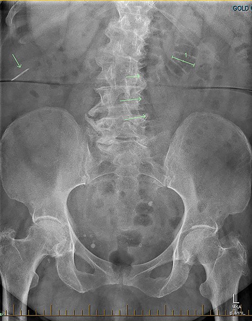 AXR shows a linear hyperdensity in the right upper quadrant.