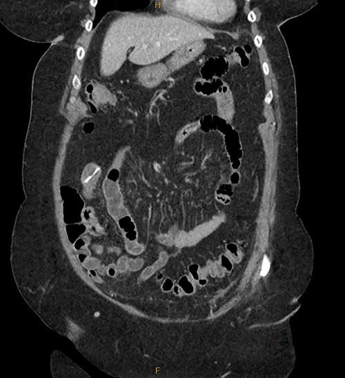 Initial CT imaging for patient RF.