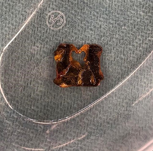 A significantly degraded clip suggested that the object had been present for a prolonged period. An expiration date could not be seen.