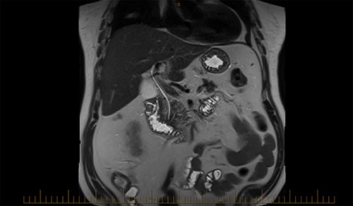 Filling defect within the duodenum on MRCP.