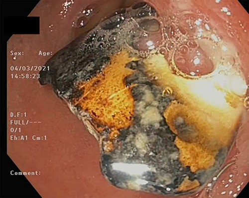 BC embedded in the duodenal mucosa.