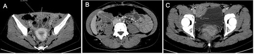 Computed tomography at diagnosis showing the three tissular lesions adherent to the anterior abdominal wall. (A) Tumor in contact with infra-umbilical linea alba. (B) Lesion located at the right hypochondria. (C) Tumor situated in the right iliac fossa near the bladder.