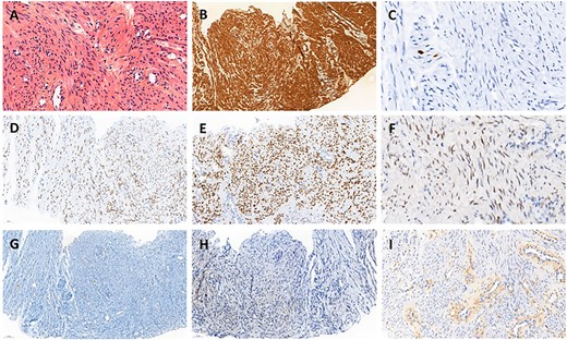 Histopathology of biopsy. (A) Smooth muscle cells with bland cytology, hematoxylin eosin stain ×400. (B) Strong positivity for smooth muscle actin, ×200. (C) Proliferative index evaluated with Ki67 was very low, ×200. (D) Strong and diffuse nuclear expression of estrogen receptors, ×200. (E) Strong and diffuse nuclear expression of progesterone receptors, ×200. (F) Heterogeneous expression of androgen receptors, ×200. (G) Tumor cell negativity for CD117, ×200. (H) Tumor cell negativity for HMB45, ×200. (I) Tumor cell negativity for EGFR, ×200.