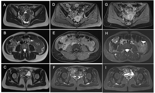 Comparative magnetic resonance imaging (MRI). (A–C) MRI after 3 months of acetate ulipristal. (A) Tumor in contact with infra-umbilical linea alba; (B) lesion located in right hypochondria; (C) tumor situated in right iliac fossa near bladder. (D–F) MRI after 3 months of AI and GnRH agonist. (G–I) preoperative MRI.