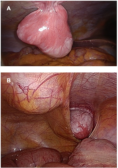 Three lesions seen by laparoscopy. (A) Lesion located in right hypochondria; (B) Right iliac fossa and linea alba tumors.