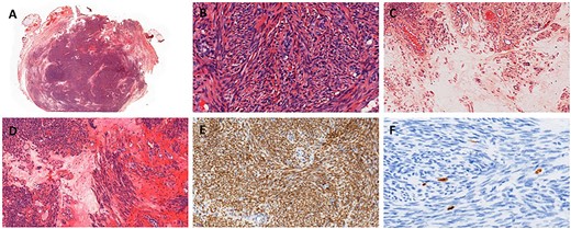 Histopathology of resection. (A) Hematoxylin eosin stain. (B) Spindle-shaped cells without atypia, hematoxylin eosin stain ×400. (C) Edema, hematoxylin eosin stain ×200. (D) Edema and fibrosis, hematoxylin eosin stain ×200. (E) Nuclear strong and diffuse expression of estrogen receptors, ×200. (F) Proliferative index evaluated with Ki67 ~1%, ×400.