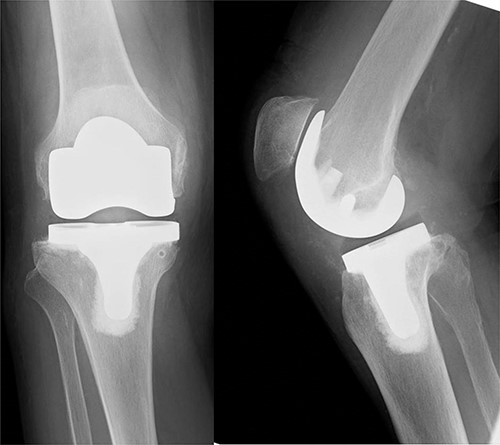 X-ray examination showed a patellar alta.