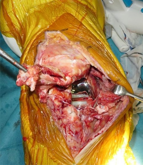 The patellar tendon was found to be ruptured and completely detached from the tibial tuberosity.