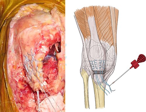 The patellar tendon was completely detached from the tibial tuberosity, and Krakow sutures were applied to both sides of the tendon using flat-braided sutures.