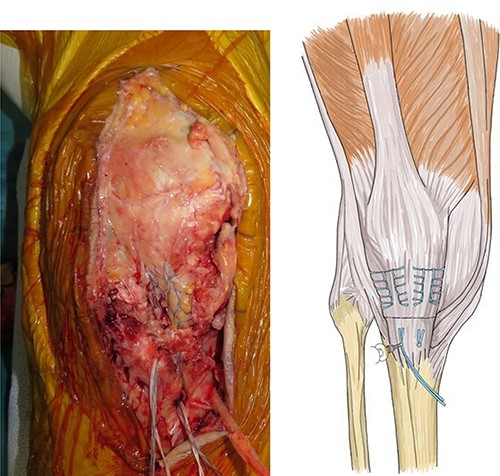 The flat-braided sutures were fixed to the tibial tuberosity using a fully threaded Twist-In knotless anchor (SwieveLock®); after pulling the tendon to the tuberosity, it was fixed with two anchors on both sides of the tuberosity.