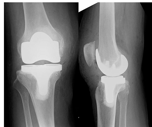 X-ray, 3 months post-operatively, did not show any patellar alta.