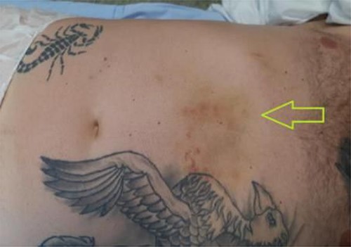 Handlebar sign—bruising in the epigastric region (green arrow). Patient lying supine.